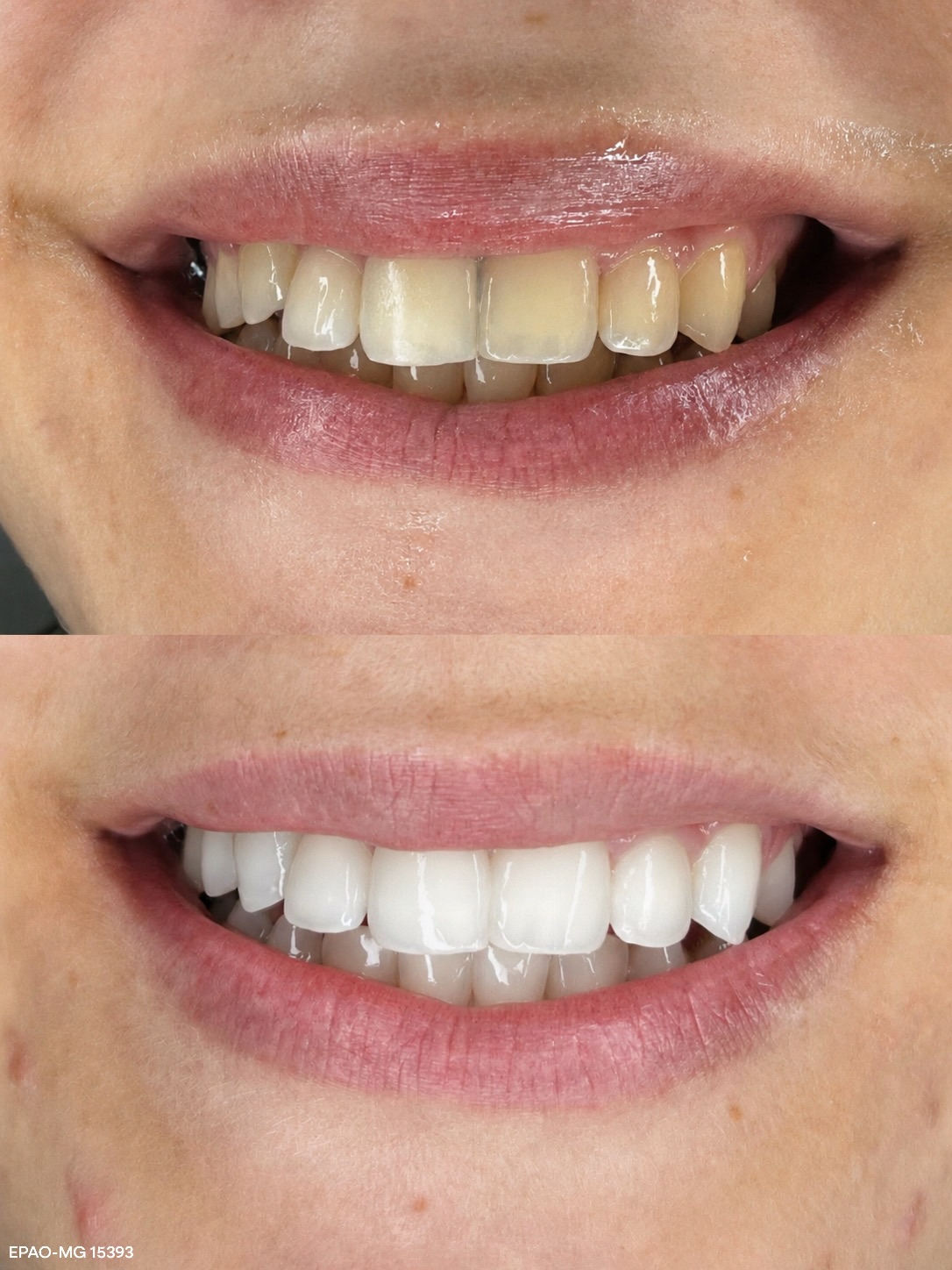 Antes e depois de clareamento e facetas dentárias