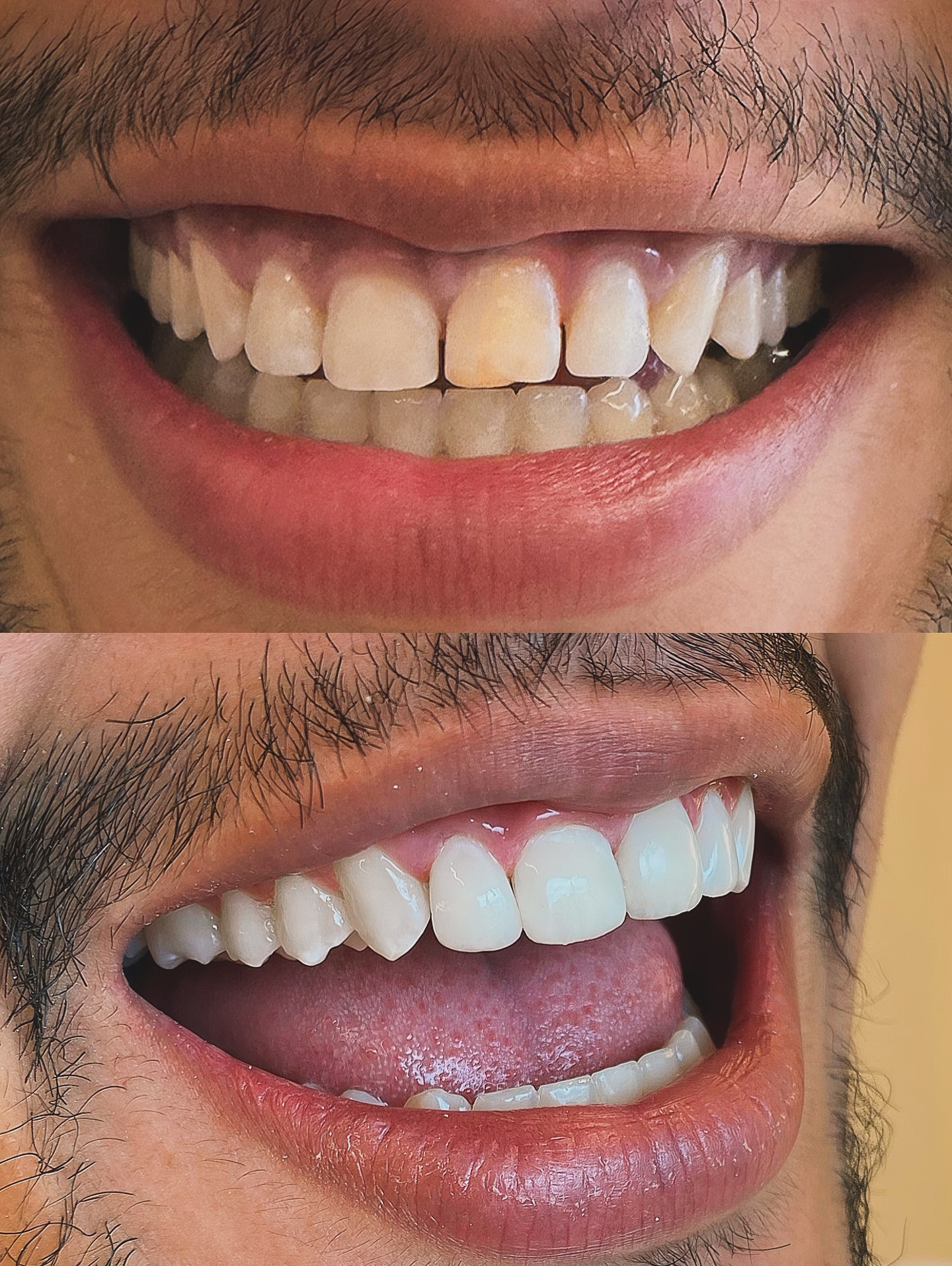 Antes e depois de clareamento dental