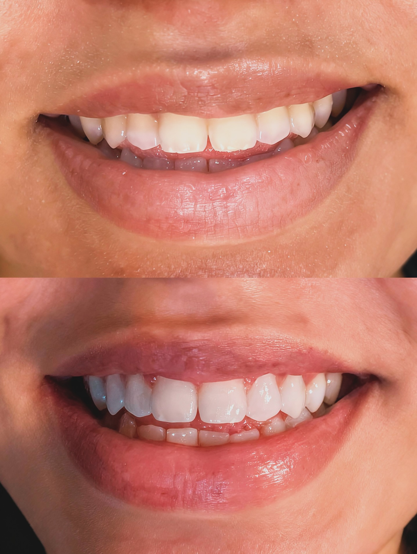 Antes e depois de faceta dentária