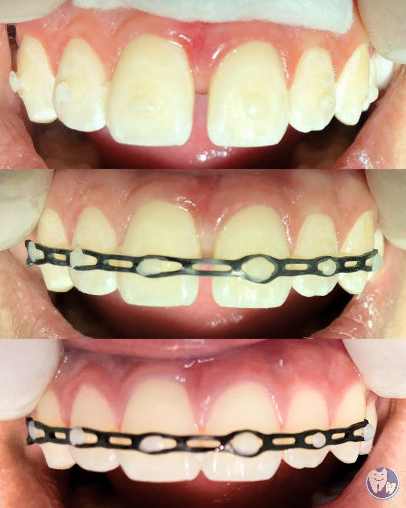 Antes e depois de tratamento ortodôntico