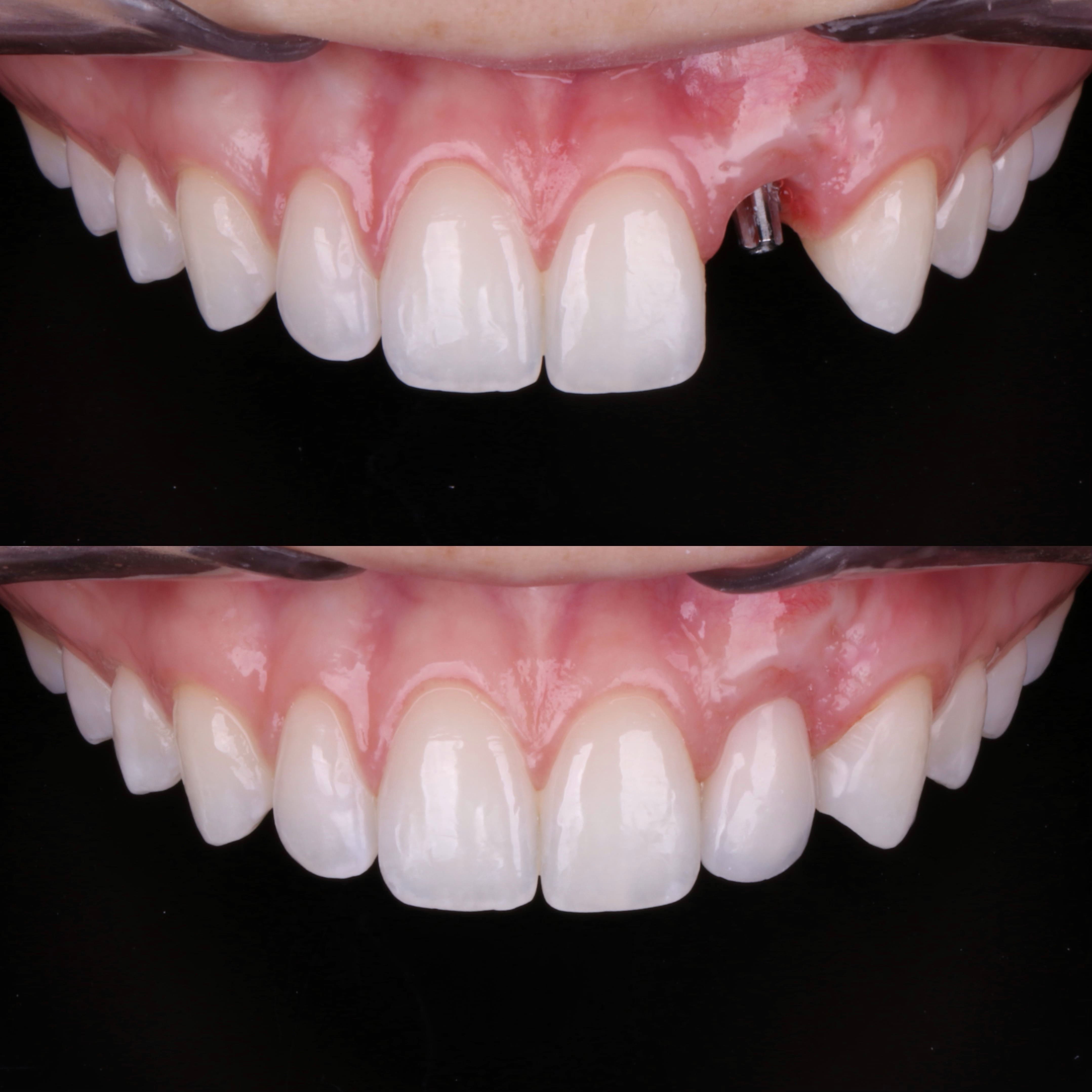 Implantodontia, antes e depois